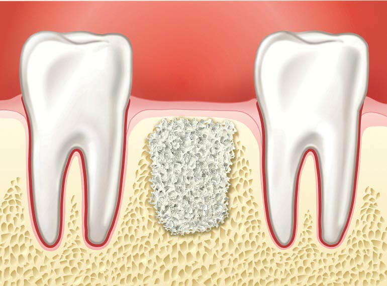 Использование костных материалов в стоматологии.